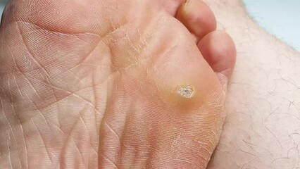 Wart on the foot, leg. HPV, blister, skin wart.