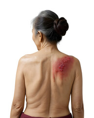 Boil infection on the back shoulder of an elderly asian woman on transparent background