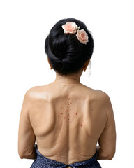 Boil infection on the back of an elderly asian woman on transparent background.