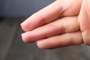 A red spot on the fingers. Skin diseases. Treatment of the skin of the hands. Healthy Skin