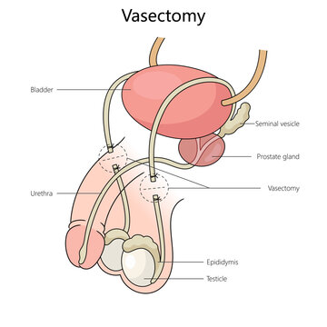 vasectomy on the male reproductive system, highlighting key anatomical features structure diagram hand drawn schematic vector illustration. Medical science educational illustration