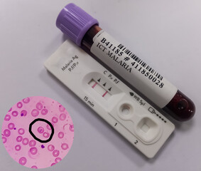 Malarial Parasite(MP) Test, Medical check up test, to identified by examining under the microscope...