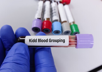 Technician hold blood sample for Kidd blood grouping