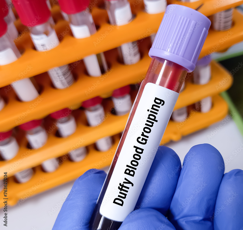 Canvas Prints Technician hold blood sample for Duffy blood grouping. blood grouping system.