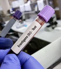 Technician hold blood sample for Er Blood Group System.