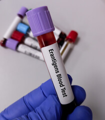 Fototapeta premium Technician hold blood sample for Er Blood Group System.