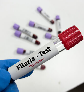 Blood sample for Filaria test with medical laboratory background. Filariasis.