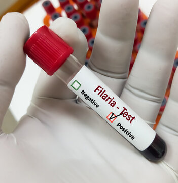 Blood sample for Filaria test with medical laboratory background. Filariasis.