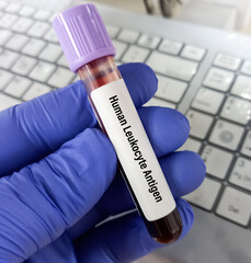 Test tube with blood sample for HLA (Human Leukocyte Antigen) typing test.