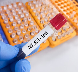 Blood sample for ALT (SGPT), AST (SGOT) test, liver function test.