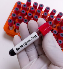 Biochemist holds blood sample for Serum Lipase test, used to diagnose acute (sudden) pancreatitis...