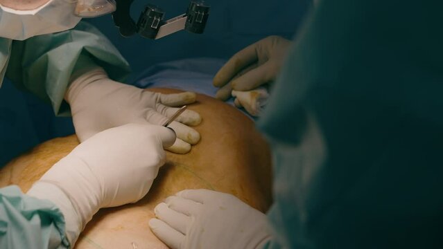 Two men doctors surgeon physician hands cut scalpel make incision on patient abdomen stomach belly plastic surgery cesarean section surgical operation medicine in hospital clinic emergency health care