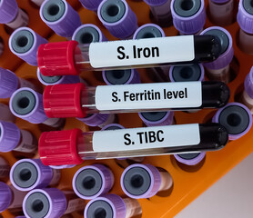 Biochemist holds blood sample for Serum Iron Profile test. Iron deficiency anemia, TIBC and...
