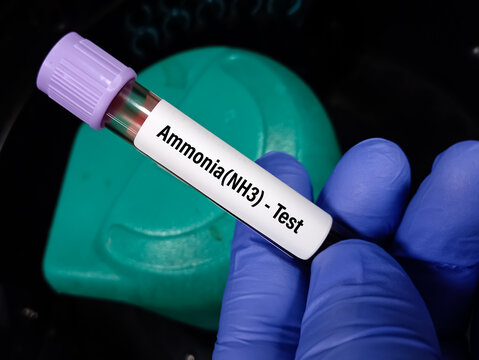 Blood sample for Ammonia test to diagnosis of ammonia levels also known as hyperammonemia. urea cycle deficiencies.