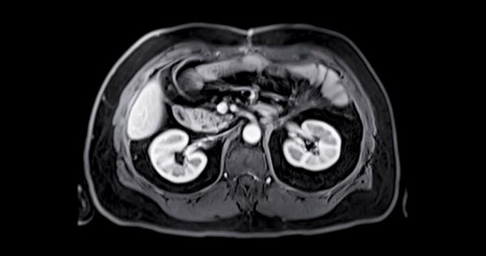 MRI of the upper abdomen axial view is a non-invasive imaging technique providing detailed visuals of organs like the liver, pancreas, and kidneys.