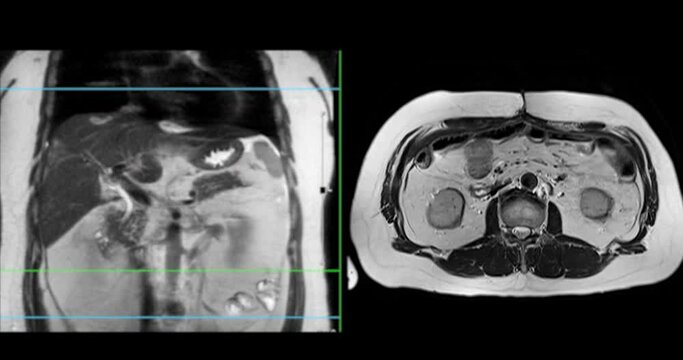 MRI of the upper abdomen axial view is a non-invasive imaging technique providing detailed visuals of organs like the liver, pancreas, and kidneys.