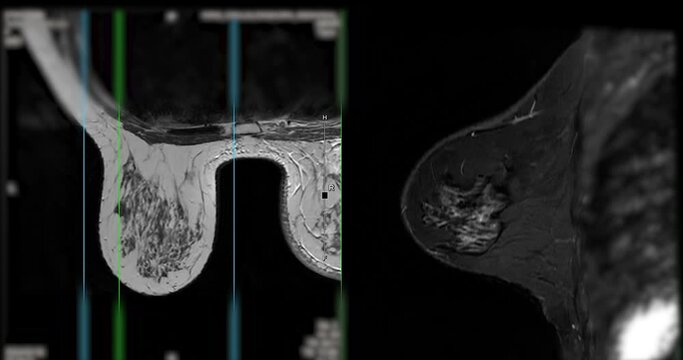 Breast MRI revealing BI-RADS 4 in women indicates suspicious findings warranting further investigation for potential malignancy and  biopsy to confirm the presence of cancerous lesions.