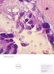 This pathologic  photograph highlights the atrium Myxoma cell nest. Atrial myxoma is a benign tumor of the heart.