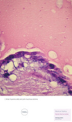 Pathologic changes in atrial myxoma, this image shows myxoma cells and pink mucinous stroma. Atrial myxoma is a benign tumor of the heart.