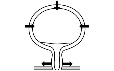 Medical illustration of the normal bladder, how it urinates, and how it urinates