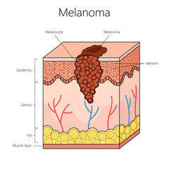 melanoma skin cancer with a focus on melanocyte and skin layers including the epidermis and dermis structure diagram hand drawn schematic vector illustration. Medical science educational illustration - obrazy, fototapety, plakaty