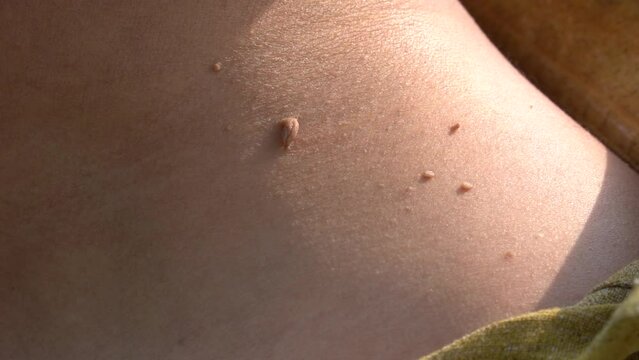 Preparing procedure for medical surgery. Laser skin tags removal. Skin Tags on Neck. Cancer papilloma on the skin wart close up