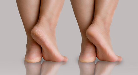 Feet with dry skin before and after treatment, comparison of a dry heel with clean healthy foot....