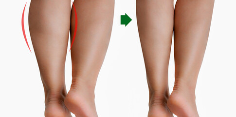 Comparison woman's legs before and after reduce size by botox or liposuction.