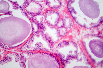 Benign prostatic hyperplasia, light micrograph