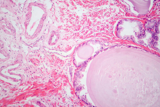 Benign prostatic hyperplasia, light micrograph