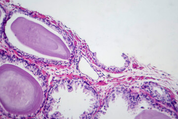 Benign prostatic hyperplasia, light micrograph