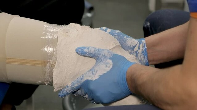 Prosthetic leg, Workplace tools and cast development. In a professional workshop, a man makes a plaster model of a prosthetic leg for a patient.