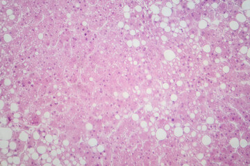 Hepatic steatosis, light micrograph