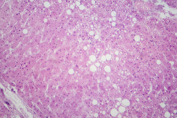 Hepatic steatosis, light micrograph