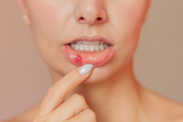 A young woman shows a close-up of a stomatitis ulcer in the acute stage on the mucous membrane of the mouth. Oral problems - obrazy, fototapety, plakaty