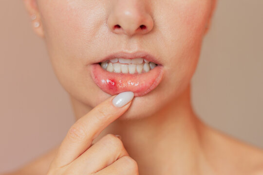 A young woman shows a close-up of a stomatitis ulcer in the acute stage on the mucous membrane of the mouth. Oral problems
