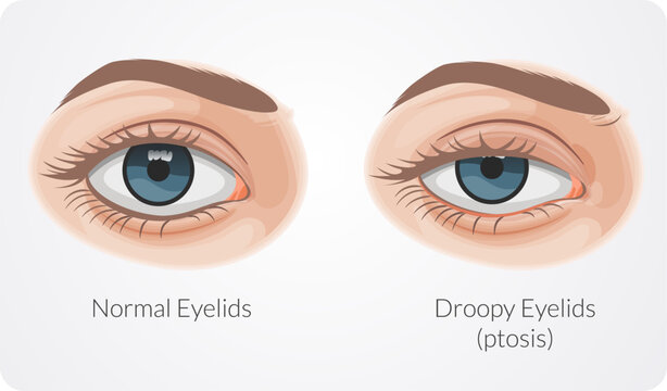 Ptosis drooping upper eyelid - Stock Illustration