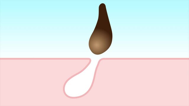 毛穴の汚れ　肌断面　角栓　アニメーション