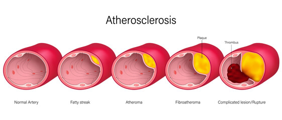 Atherosclerosis vector. Cardiovascular Disease. Coronary artery syndrome. Clogged artery. Causes of myocardial ischemia. 