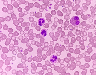 Photomicrograph of hematological slide showing RBC, WBC (Neutrophils and Eosinophil) and platelet. Normal hemogram. CBC.