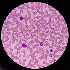 Photomicrograph of hematological slide showing RBC, WBC (Neutrophils, Lymphocyte, monocyte) and...