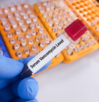 Scientist hold a test tube with blood sample for Serum Vancomycin test, therapeutic drug level monitoring.