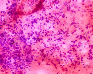 CT guided FNA from abduminal mass: Spindle cell neoplasm, smear show cellular material of oval to...