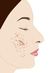 Woman's face blemish melasma, illustration on white background