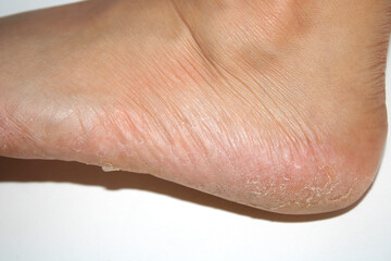 Peeling skin on the feet from excessive sweating in the heel area.