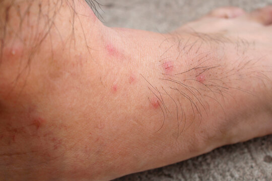 There are red blisters on the feet from a Red imported fire ant bite.