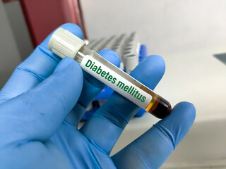 Blood sample for blood sugar levels test. To diagnosis Diabetics Mellitus and insipidus.