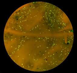Sputum smear microscopic examination show Microbacterium Tuberculosis Bacteria (MTB) . TB patients...
