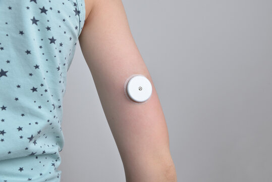 Child's hand with white sensor for continuous glucose monitoring. Concept of health, diabetes management, medical technology, and monitoring solutions