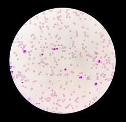 Photomicrograph of hematological slide showing severe anemia. Hemolytic anemia, iron deficiency anemia.